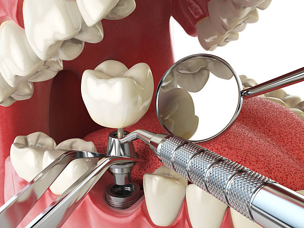 Best Emergency Wisdom Tooth Extraction in Marietta, OH